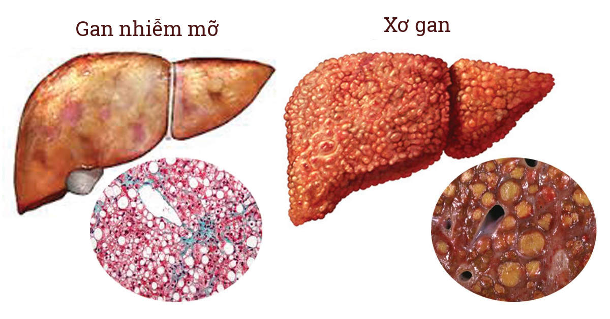 GAN NHIỄM MỠ :NGUYÊN NHÂN ,TRIỆU CHỨNG VÀ CÁCH ĐIỀU TRỊ