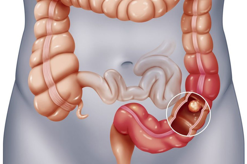 Quan niệm của Đông y về bệnh viêm đại tràng