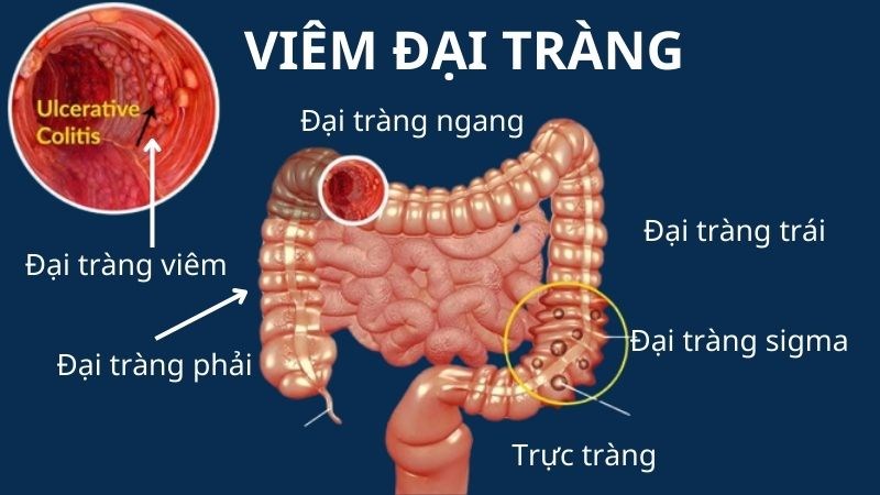 Những điều cần biết về Viêm đại tràng