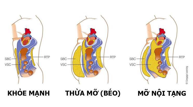 Mỡ nội tạng: Những điều cần biết